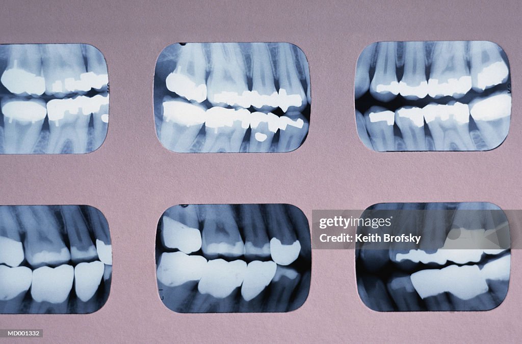 Dental X-rays