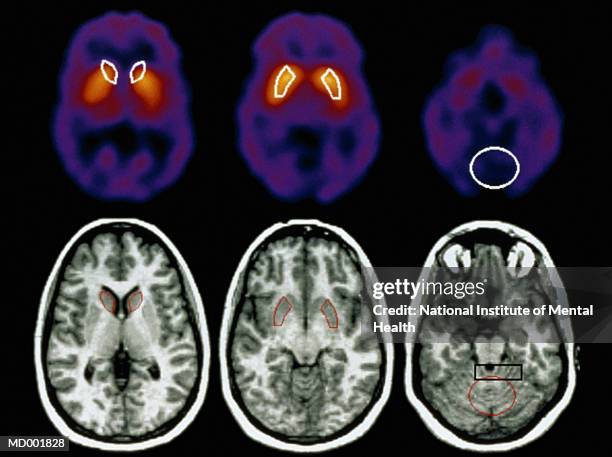 brain scans - 3rd foundation day of institute of liver and biliary sciences stockfoto's en -beelden