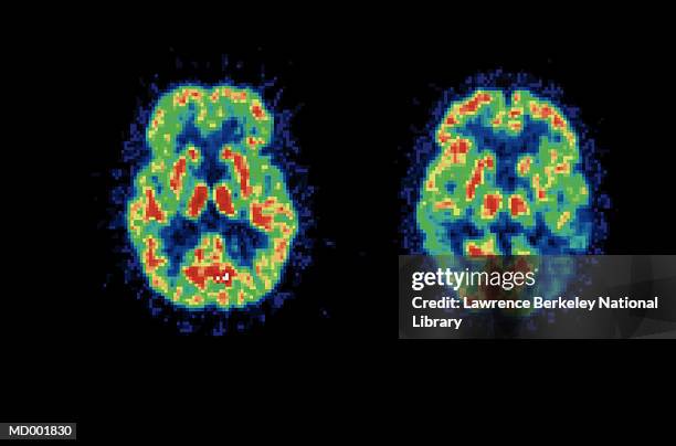 Depression Brain Scan Photos et images de collection - Getty Images