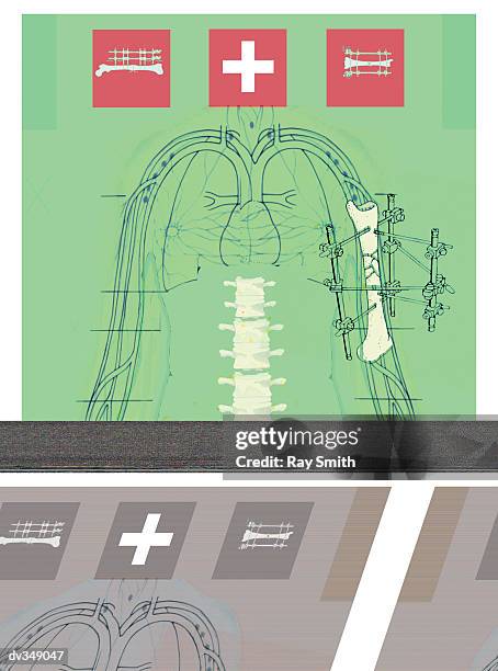 mending broken bone - humerus stock illustrations