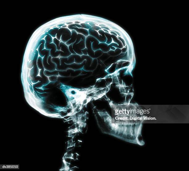 x-ray of brain in skull - skull xray no brain stock pictures, royalty-free photos & images