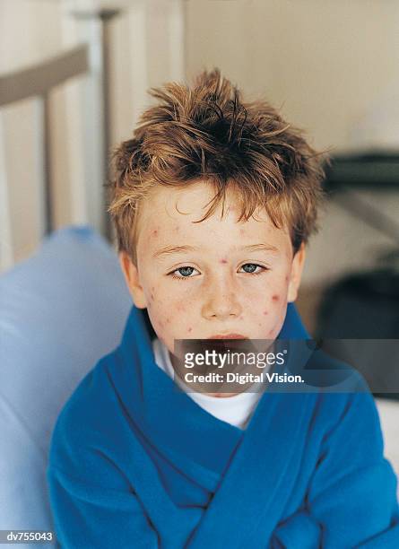 portrait of a boy with chickenpox - varicela fotografías e imágenes de stock