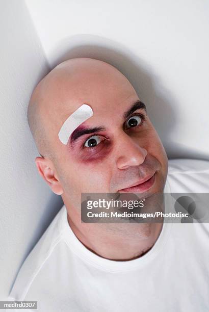 bald man with bandage and black eye, extreme close-up, tilt - eye black fotografías e imágenes de stock