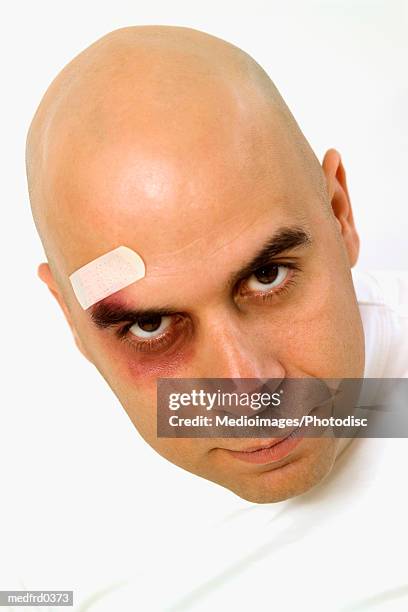 bald man with bandage and black eye, close-up - eye black fotografías e imágenes de stock