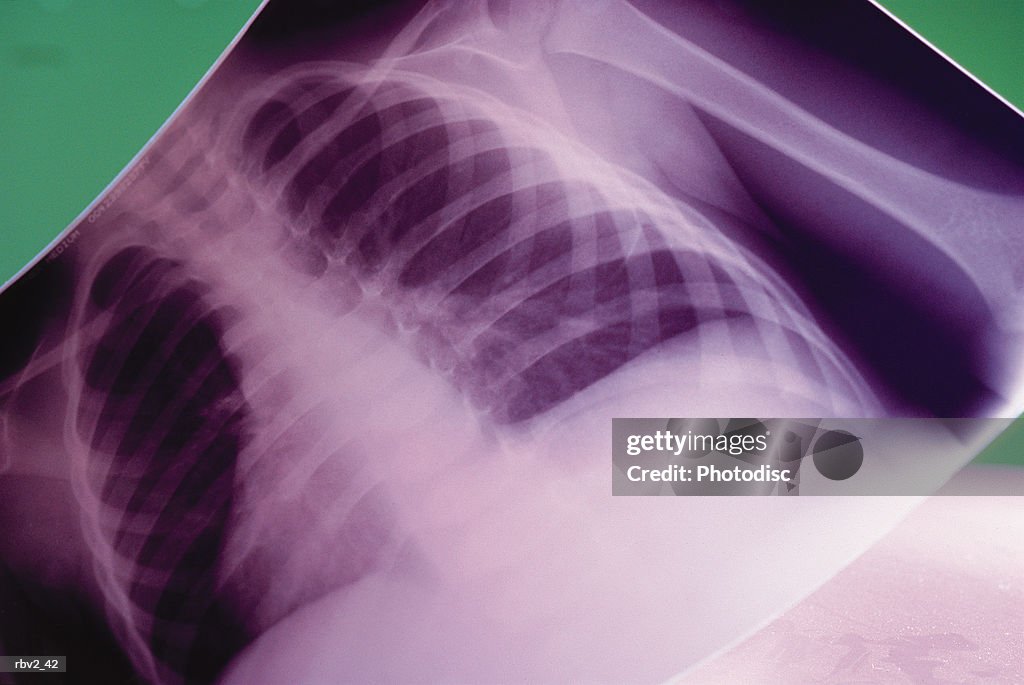 An x-ray of a chest and ribs rests on a green background