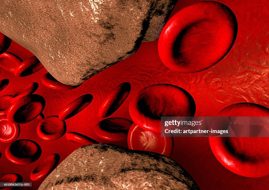 Blood vessel with arteriosclerosis