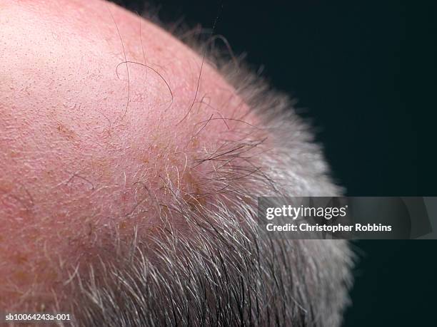 macro shot of man's bald spot - parcialmente calvo - fotografias e filmes do acervo