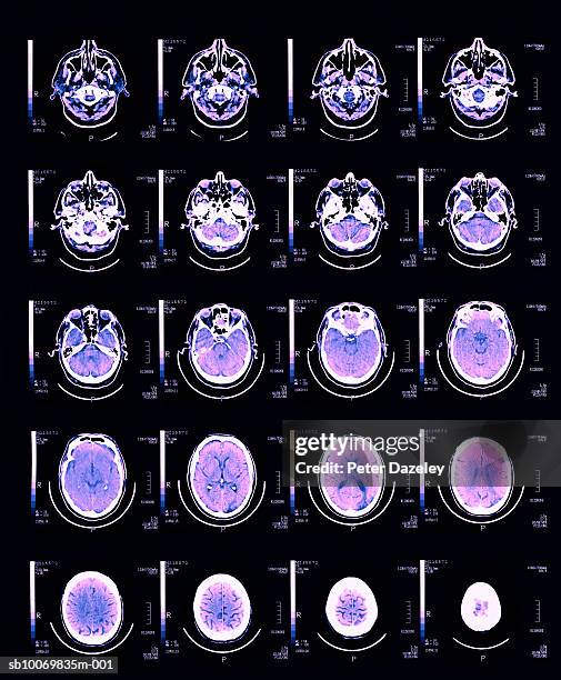 mri brain scan, close-up - mri scan medische scan stockfoto's en -beelden