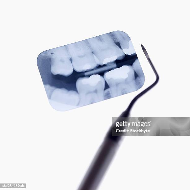 close-up of a teeth x-ray and plaque remover - dental imaging stock pictures, royalty-free photos & images