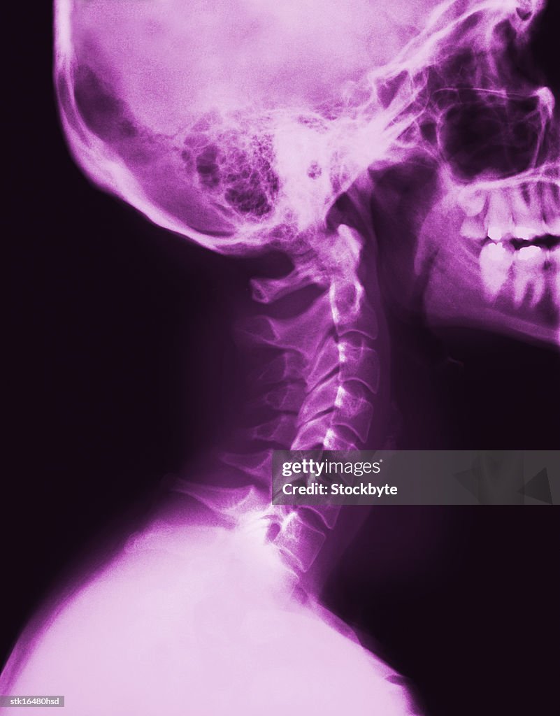 Side profile x-ray image on a human neck and skull