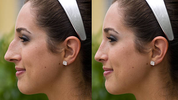antes e depois de cirurgia plástica - rinoplastia - fotografias e filmes do acervo