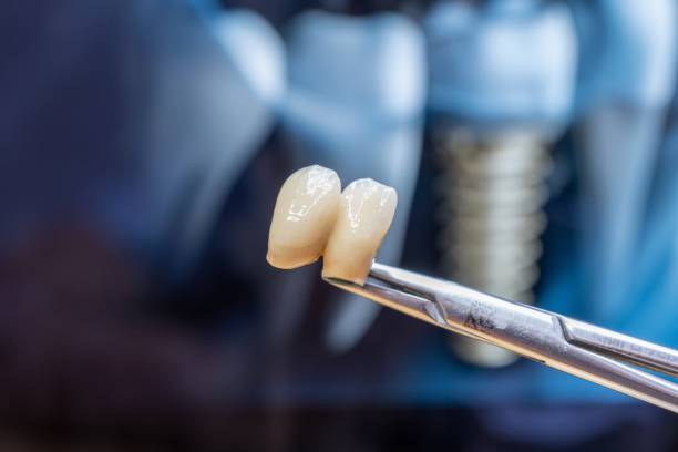 ceramic glazed dental crowns - implante dentário - fotografias e filmes do acervo