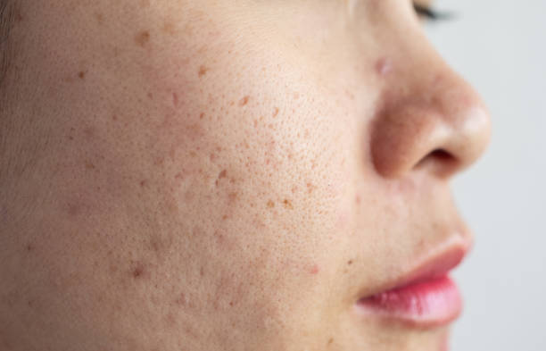 close up of asian woman face has problems with aging skin/acne scar on her face. - skin pores stock pictures, royalty-free photos & images