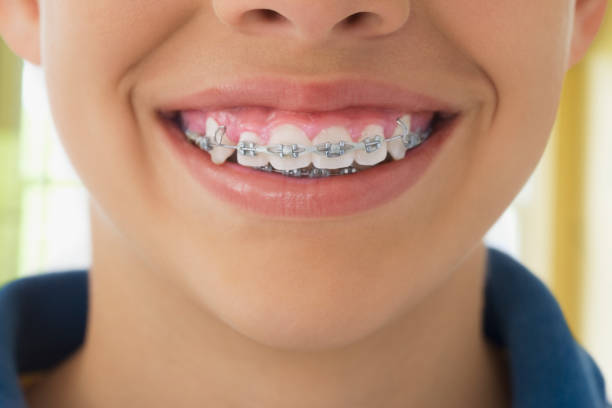 close up of braces hispanic boy's teeth - ortodontia aparelho  - fotografias e filmes do acervo