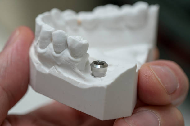 dental implant model - implante dentário - fotografias e filmes do acervo
