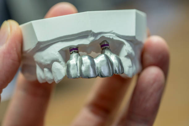dental technician holding a dental implant metal framework picture