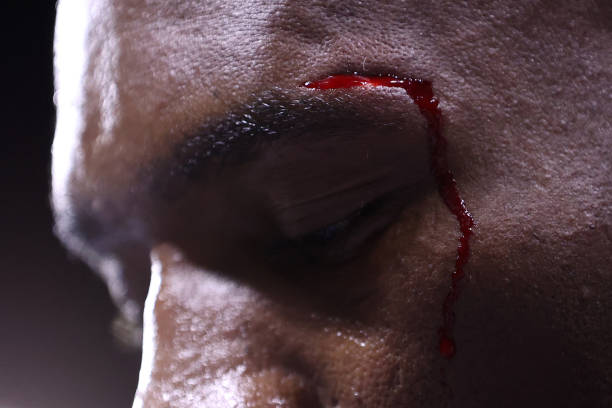 Detailed view of the cut of Michel Soro after the fight is called a no contest during the Matchroom fight night at The O2 Arena on July 09, 2022 in...