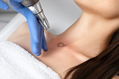 Doctor beautician makes laser tattoo removal on the neck of a young brunette woman in the salon. Aesthetic cosmetology, skin treatment and tattoo removal.