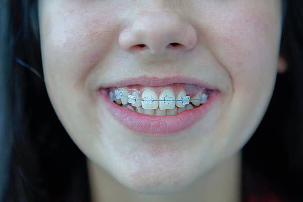girl in white braces - ortodontia aparelho  - fotografias e filmes do acervo