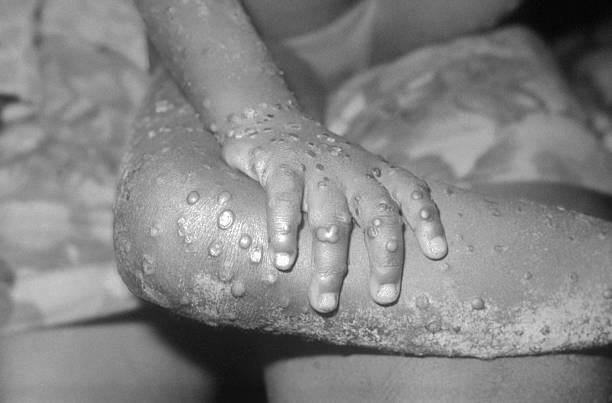 Monkeypox Pictures You Will Ever See - Best School News