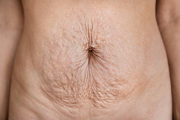 mother's belly after childbirth - plastica abdominal - fotografias e filmes do acervo