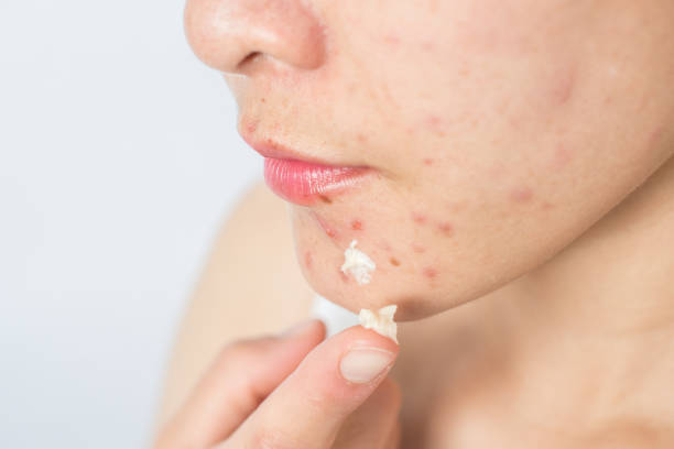 portrait of young asian woman having acne problem and she applying acne cream on her face. - acne face stock pictures, royalty-free photos & images