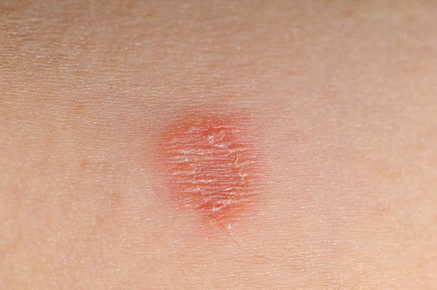 tinea corporis infection (ring worm) - ringworm  stock pictures, royalty-free photos & images