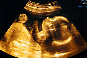Ultrasound of a woman's fetus at 37 weeks