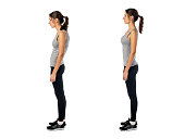 Woman with impaired posture position defect scoliosis and ideal bearing